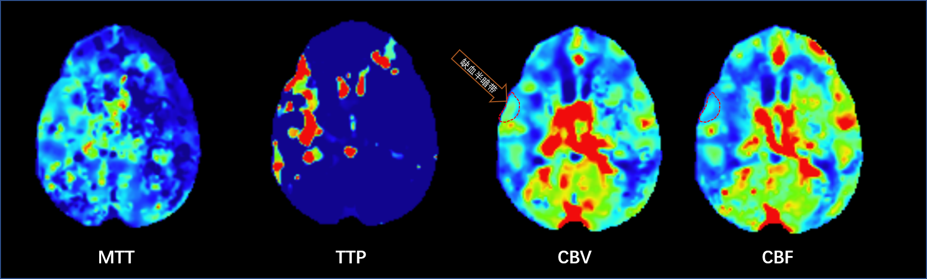 基于CT的缺血半暗帶追蹤.png